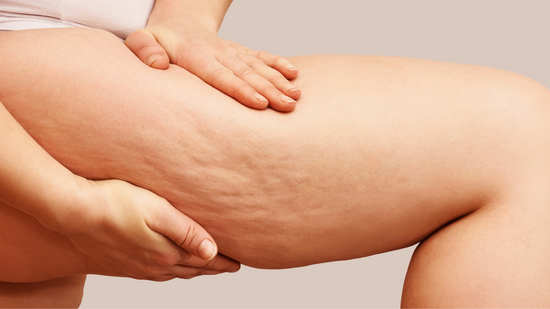 Causes of Cellulite